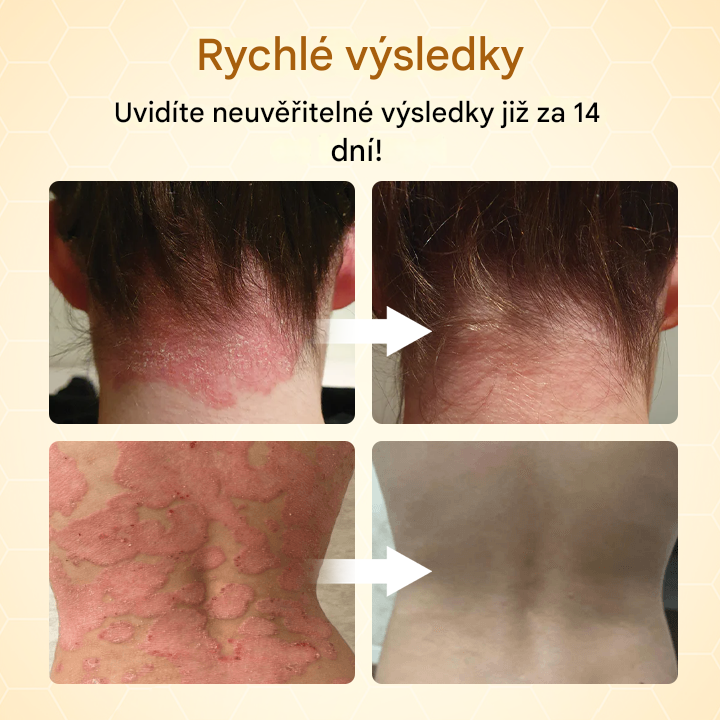 Timilk® BeeLieve Péče o pokožku s lupénkou🐝