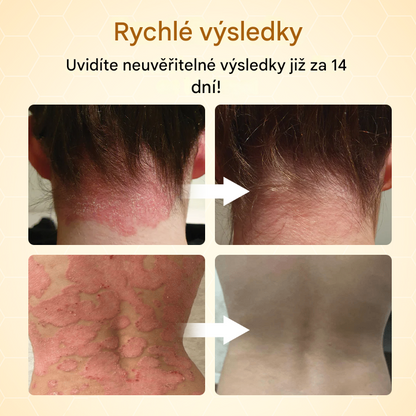 Timilk® BeeLieve Péče o pokožku s lupénkou🐝