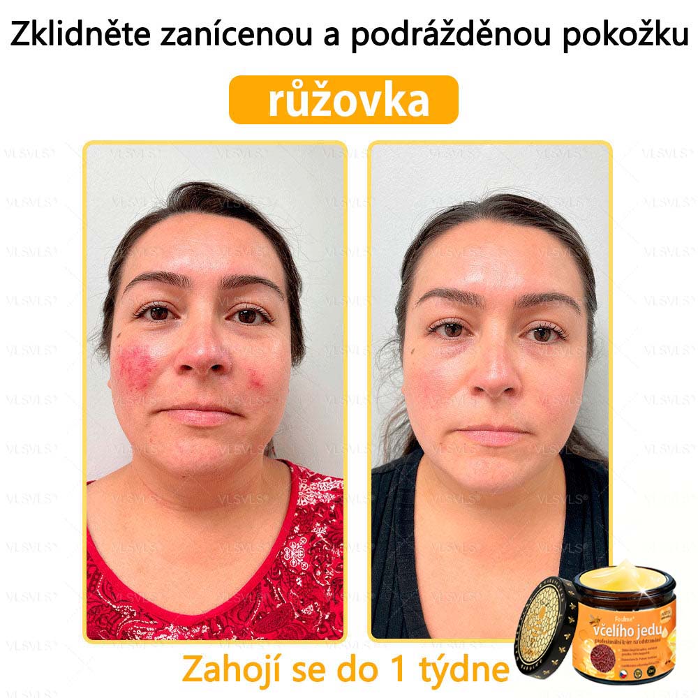 Foulme® Profesionální krém na odstranění včelího jedu🐝