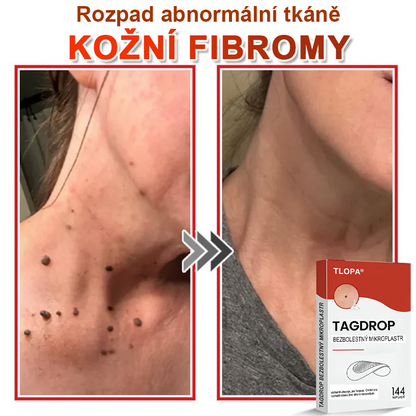 TLOPA® Mikrovpichová botanická náplast na odstranění kožních výrůstků 🇨🇿 Vyrobeno v Česká republika💥