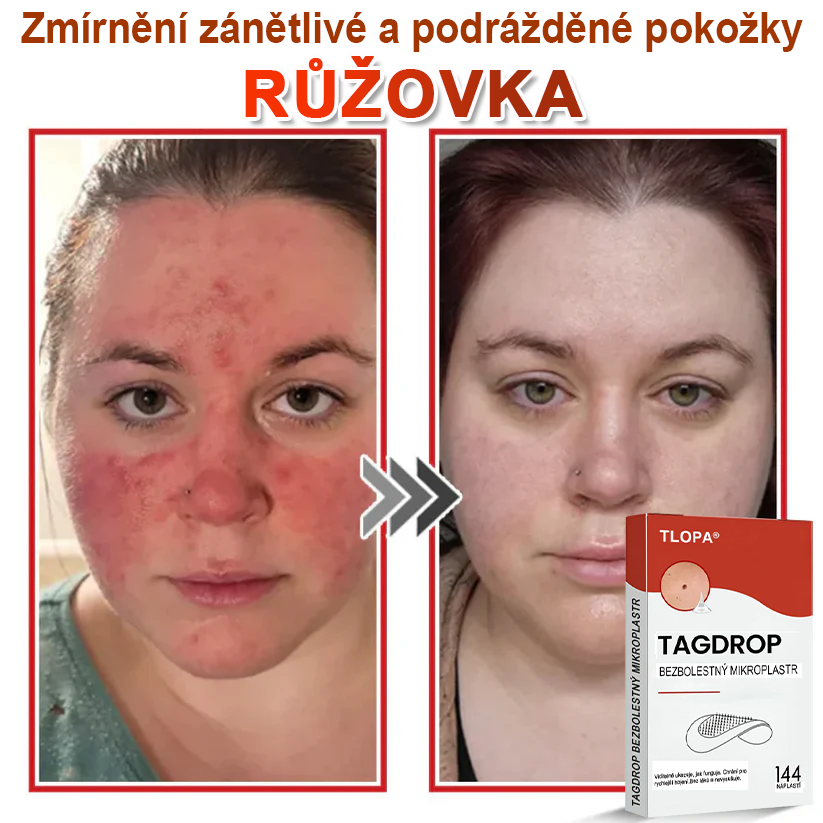TLOPA® Mikrovpichová botanická náplast na odstranění kožních výrůstků 🇨🇿 Vyrobeno v Česká republika💥