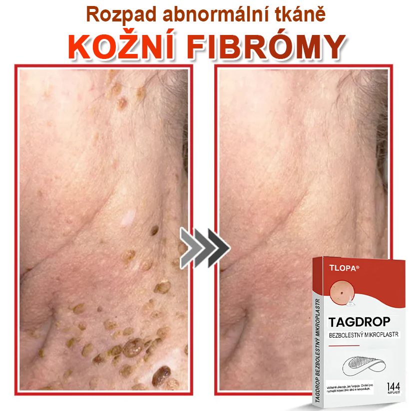 TLOPA® Mikrovpichová botanická náplast na odstranění kožních výrůstků 🇨🇿 Vyrobeno v Česká republika💥