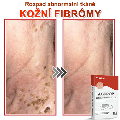 TLOPA® Mikrovpichová botanická náplast na odstranění kožních výrůstků 🇨🇿 Vyrobeno v Česká republika💥