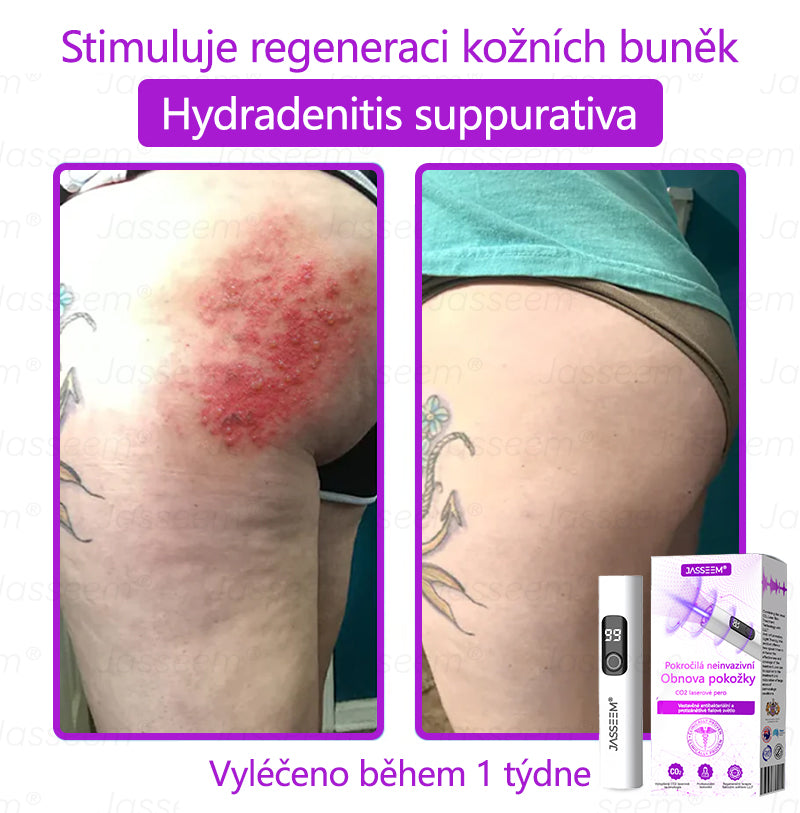 𝐉𝐚𝐬𝐬𝐞𝐞𝐦® Pokročilé neinvazivní pero s CO₂ laserem na opravu pokožky 💕 (šetrně odstraňuje bradavice, mateřská znaménka, stařecké skvrny a kožní značky - bez bolesti a rozruchu!)🌿