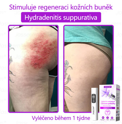 𝐉𝐚𝐬𝐬𝐞𝐞𝐦® Pokročilé neinvazivní pero s CO₂ laserem na opravu pokožky 💕 (šetrně odstraňuje bradavice, mateřská znaménka, stařecké skvrny a kožní značky - bez bolesti a rozruchu!)🌿