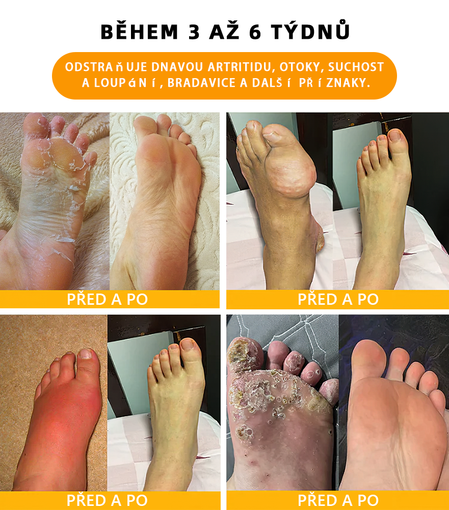 🔥💫 Poslední den na získání slevy 70 %: Aeehfeng®  Včelí jed a 30 bylinek pro detoxikaci nohou a korálky pro tvarování těla  - ✨Doporučeno Evropskou lymfatickou asociací (ELF) ✨🧀