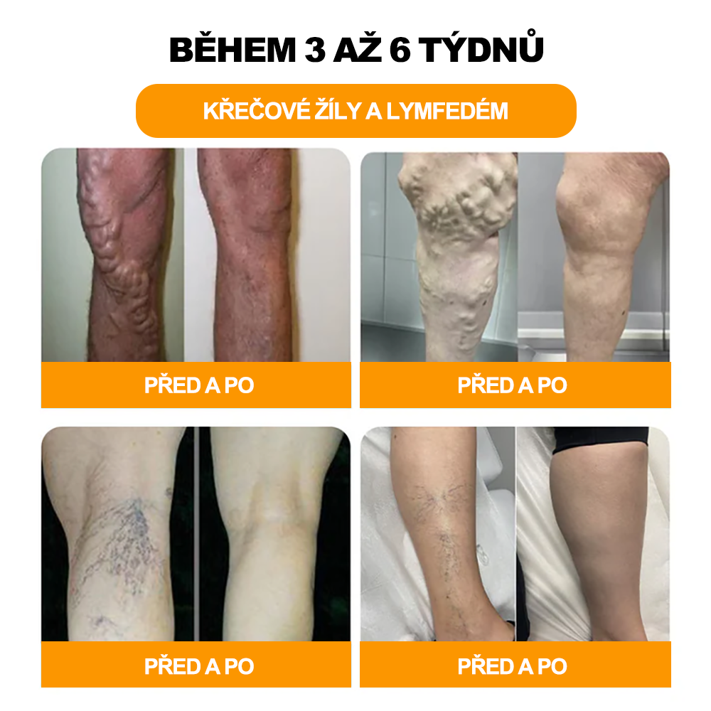 🔥💫 Poslední den na získání slevy 70 %: Aeehfeng®  Včelí jed a 30 bylinek pro detoxikaci nohou a korálky pro tvarování těla  - ✨Doporučeno Evropskou lymfatickou asociací (ELF) ✨🧀