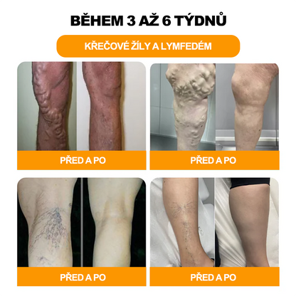 🔥💫 Poslední den na získání slevy 70 %: Aeehfeng®  Včelí jed a 30 bylinek pro detoxikaci nohou a korálky pro tvarování těla  - ✨Doporučeno Evropskou lymfatickou asociací (ELF) ✨🧀