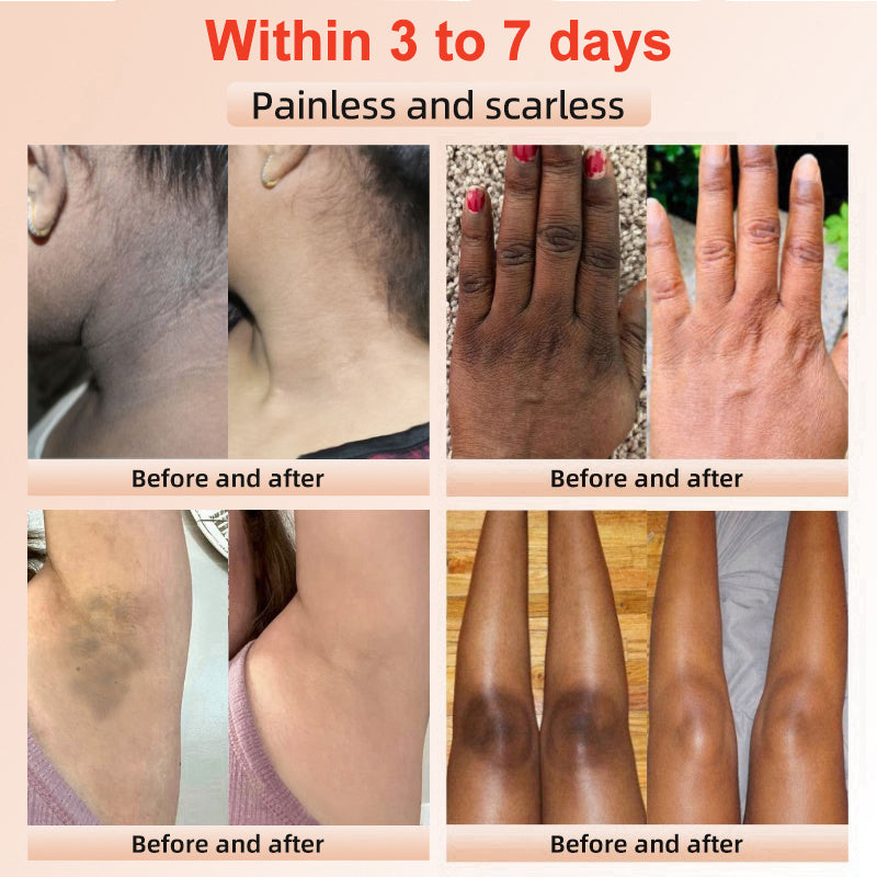 Purifying Exfoliating Gel for Acanthosis Nigricans, Exfoliation, Dark Spots, Skin Tags, and Eczema