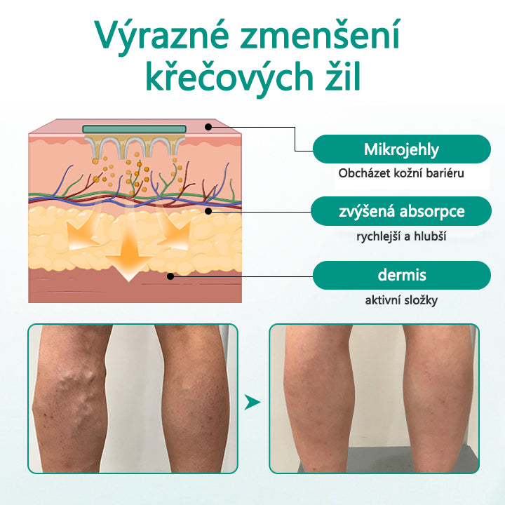 Timilk® Náplast na křečové žíly pro obnovu nohou💥