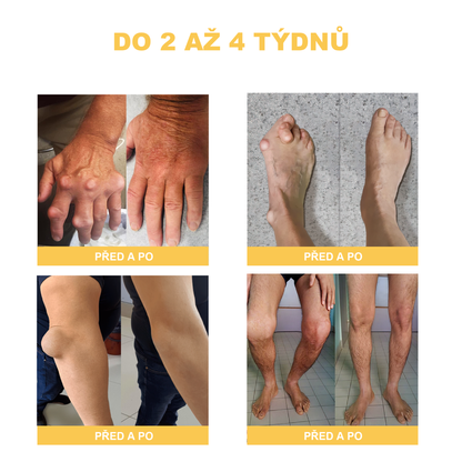 🏆🌈[✨Oficiální značkový obchod✨]Zoencgz™ Krém na léčbu artritidy a křečových žil se včelím jedem（AVLS & ACR DOPORUČUJE）