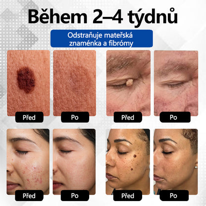 RICPIND® DermaLite Multifunkční laserové pero na odstranění bradavic a obnovu pleti