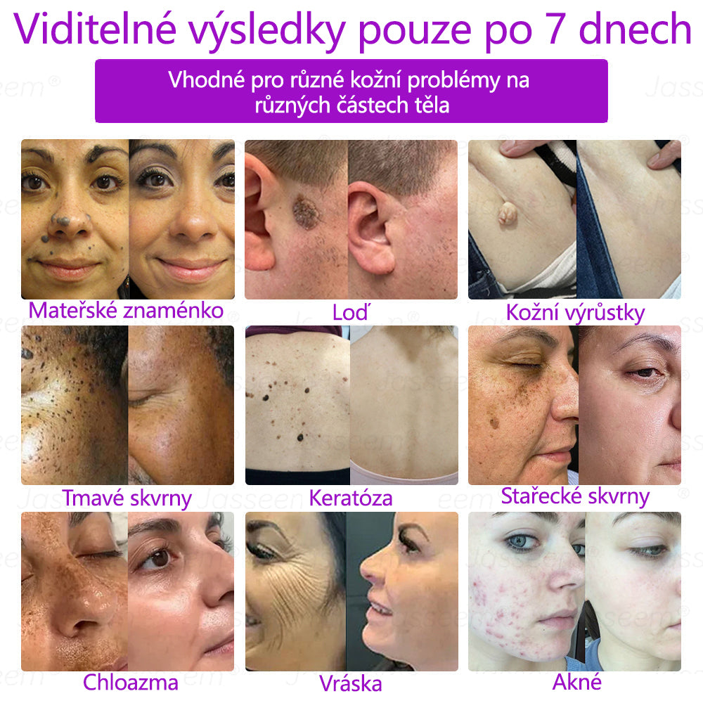 𝐉𝐚𝐬𝐬𝐞𝐞𝐦® Pokročilé neinvazivní pero s CO₂ laserem na opravu pokožky 💕 (šetrně odstraňuje bradavice, mateřská znaménka, stařecké skvrny a kožní značky - bez bolesti a rozruchu!)🌿