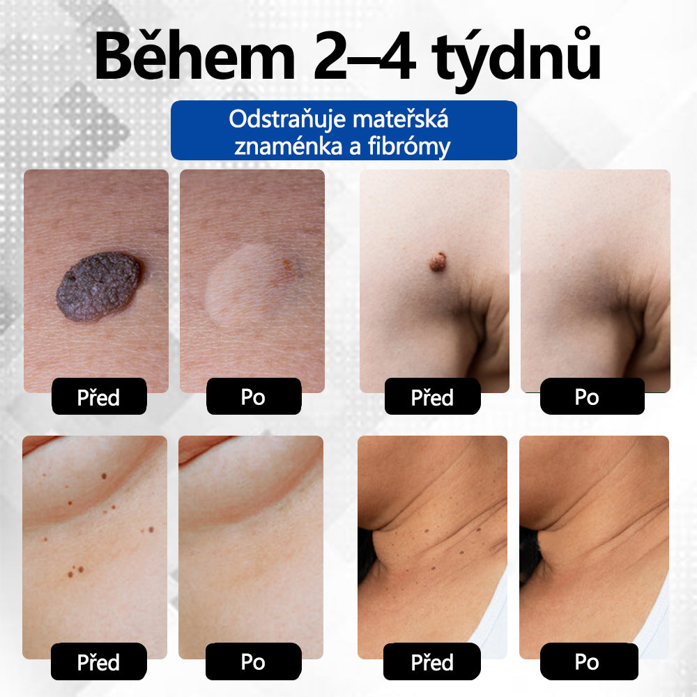 RICPIND® DermaLite Multifunkční laserové pero na odstranění bradavic a obnovu pleti