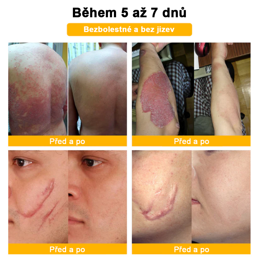 🌱🌠✨AEXZR™ Krém proti bradavicím a krtkům se včelím jedem