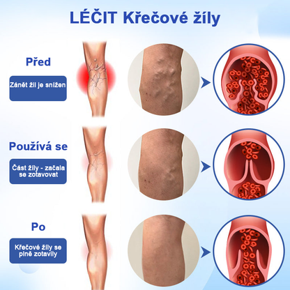 🌱🌠✨Sprej na léčbu křečových žil Veinhealing™🌿