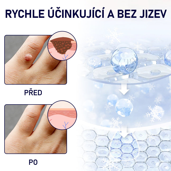 Lékárna Na Poště | Timilk® WartErase Kryogenní sprej
