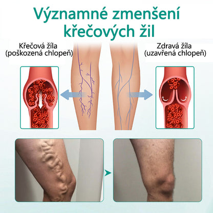 Timilk® Náplast na křečové žíly pro obnovu nohou💥
