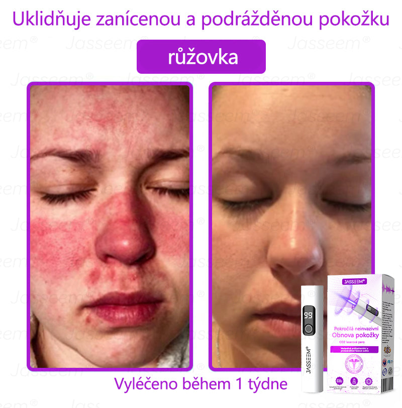 𝐉𝐚𝐬𝐬𝐞𝐞𝐦® Pokročilé neinvazivní pero s CO₂ laserem na opravu pokožky 💕 (šetrně odstraňuje bradavice, mateřská znaménka, stařecké skvrny a kožní značky - bez bolesti a rozruchu!)🌿