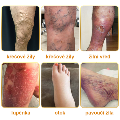 🏆🌈[✨Oficiální značkový obchod✨]Zoencgz™ Krém na léčbu artritidy a křečových žil se včelím jedem（AVLS & ACR DOPORUČUJE）