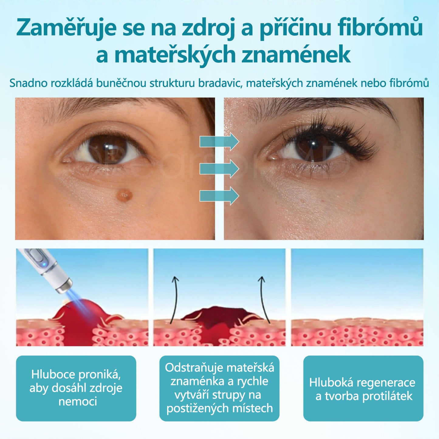 RICPIND® DermaLite Multifunkční laserové pero na odstranění bradavic a obnovu pleti