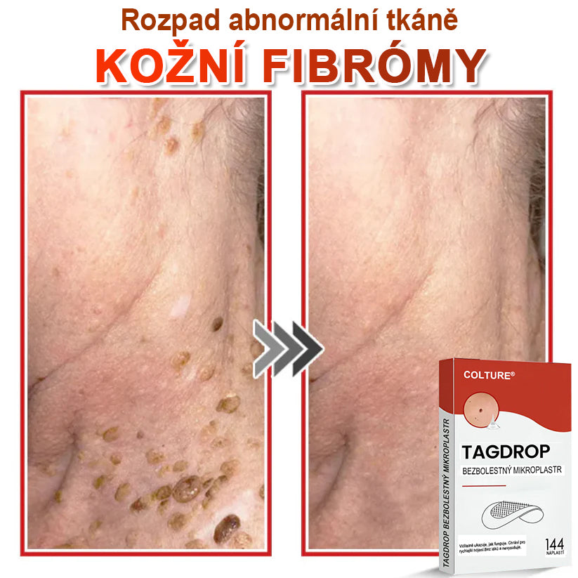 COLTURE® Mikrovpichová botanická náplast na odstranění kožních výrůstků
