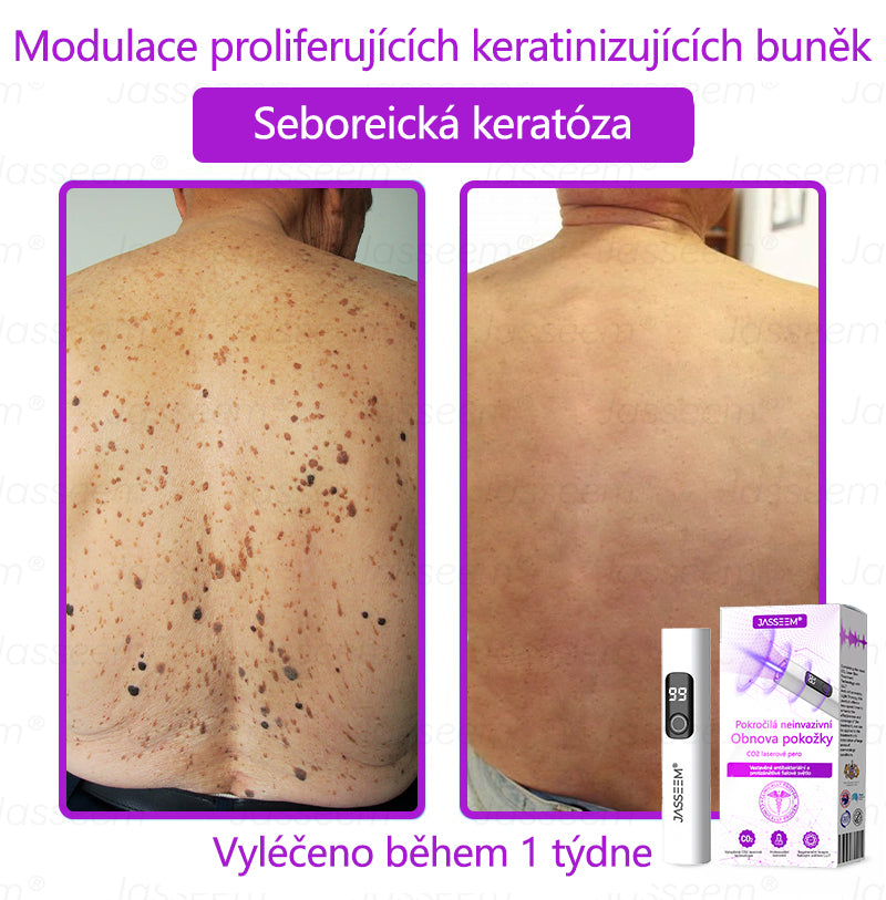 𝐉𝐚𝐬𝐬𝐞𝐞𝐦® Pokročilé neinvazivní pero s CO₂ laserem na opravu pokožky 💕 (šetrně odstraňuje bradavice, mateřská znaménka, stařecké skvrny a kožní značky - bez bolesti a rozruchu!)🌿