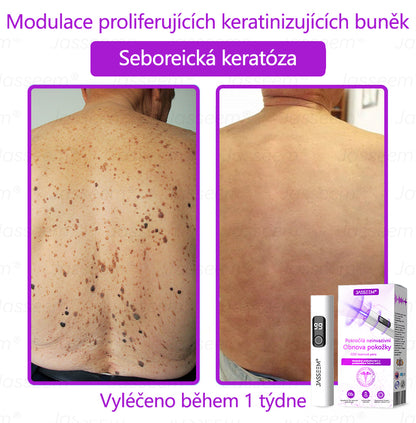 𝐉𝐚𝐬𝐬𝐞𝐞𝐦® Pokročilé neinvazivní pero s CO₂ laserem na opravu pokožky 💕 (šetrně odstraňuje bradavice, mateřská znaménka, stařecké skvrny a kožní značky - bez bolesti a rozruchu!)🌿