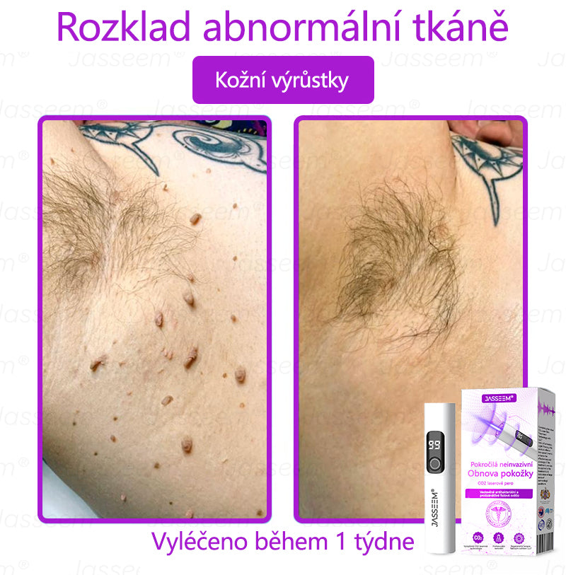 𝐉𝐚𝐬𝐬𝐞𝐞𝐦® Pokročilé neinvazivní pero s CO₂ laserem na opravu pokožky 💕 (šetrně odstraňuje bradavice, mateřská znaménka, stařecké skvrny a kožní značky - bez bolesti a rozruchu!)🌿