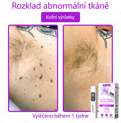 𝐉𝐚𝐬𝐬𝐞𝐞𝐦® Pokročilé neinvazivní pero s CO₂ laserem na opravu pokožky 💕 (šetrně odstraňuje bradavice, mateřská znaménka, stařecké skvrny a kožní značky - bez bolesti a rozruchu!)🌿