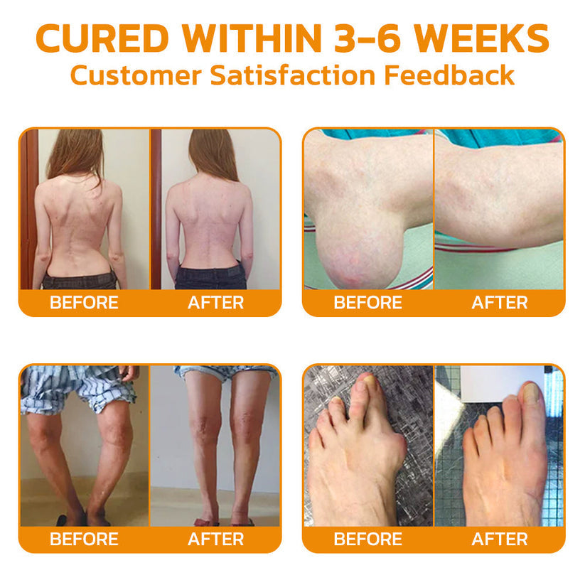 Furzero™ Krém na potlačení bolesti kloubů s včelím jedem (👩🏼‍⚕️AOA doporučuje)