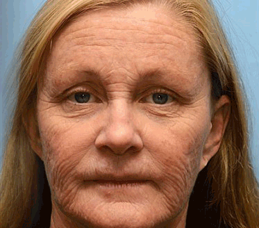 (💟Vyrobeno a odesláno z České republiky✅) Furzero™ Botox včelí jed krém na odstranění vrásek - POSLEDNÍ DEN 70% SLEVA